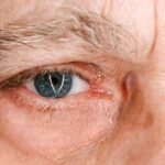 degenerazione maculare senile, maculopatia, maculopatia secca, maculopatia umida, Metodo Boel