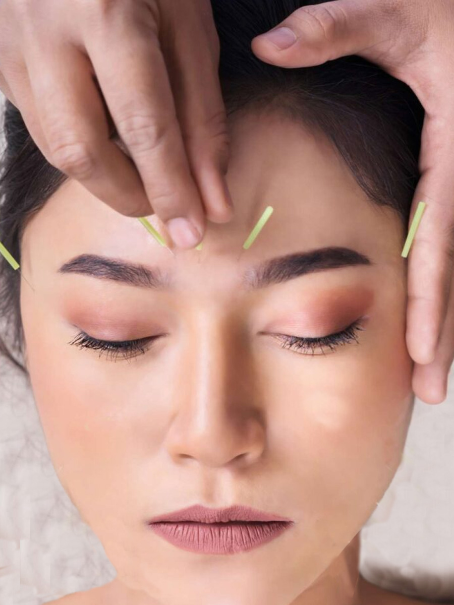 Acupuncture-points