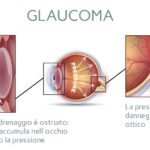 Glaucoma