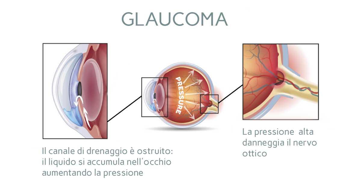 Glaucoma