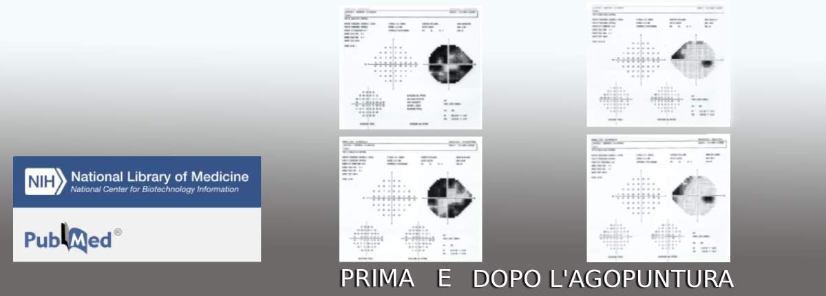 campo visivo prima e dopo l'agopuntura, Metodo Boel , Dr Marzio Vanzini