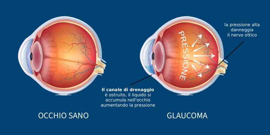 glaucoma e perfusione retrobulbare, glaucoma e cricolazione sanguigna oculare